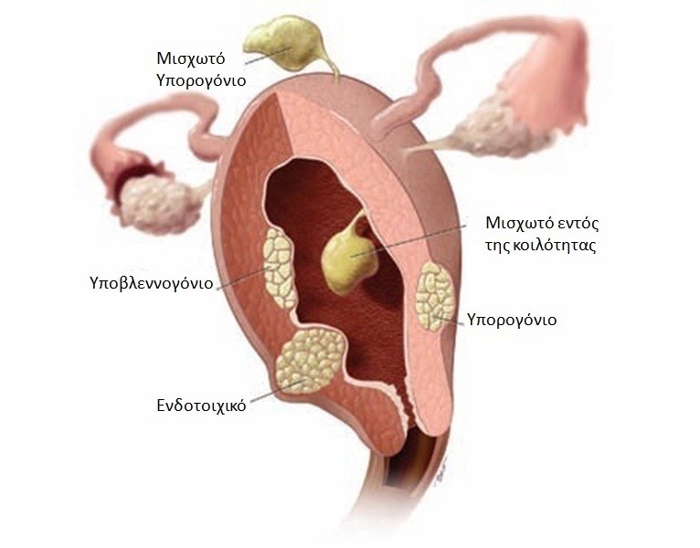 myoma2